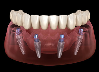 all on 4 dental implants concept pdf